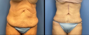 Abdominoplasty with Fleur de Lys (vertical) Incision