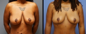 1_breast-lift-patient1