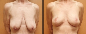 1_breast-lift-patient2