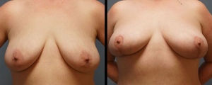 breast-lift-patient1