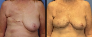 108228-Free-Flap-Breast-Reconstruction-Patient-2