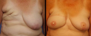 breast-reconstruction-patient1