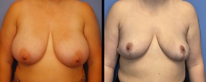 breast-reduction-patient-5