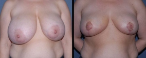 breast-reduction-patient1