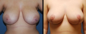 breast-reduction-patient2