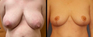 breast-reduction-patient3