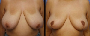 breast-reduction-patient4