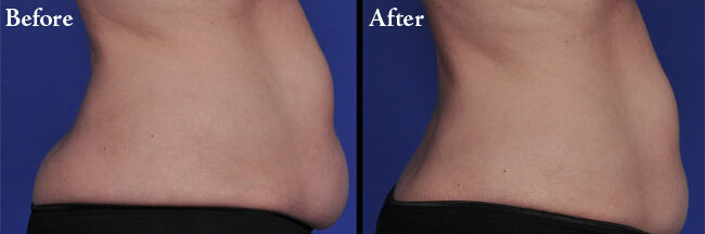 laser-fat-removal