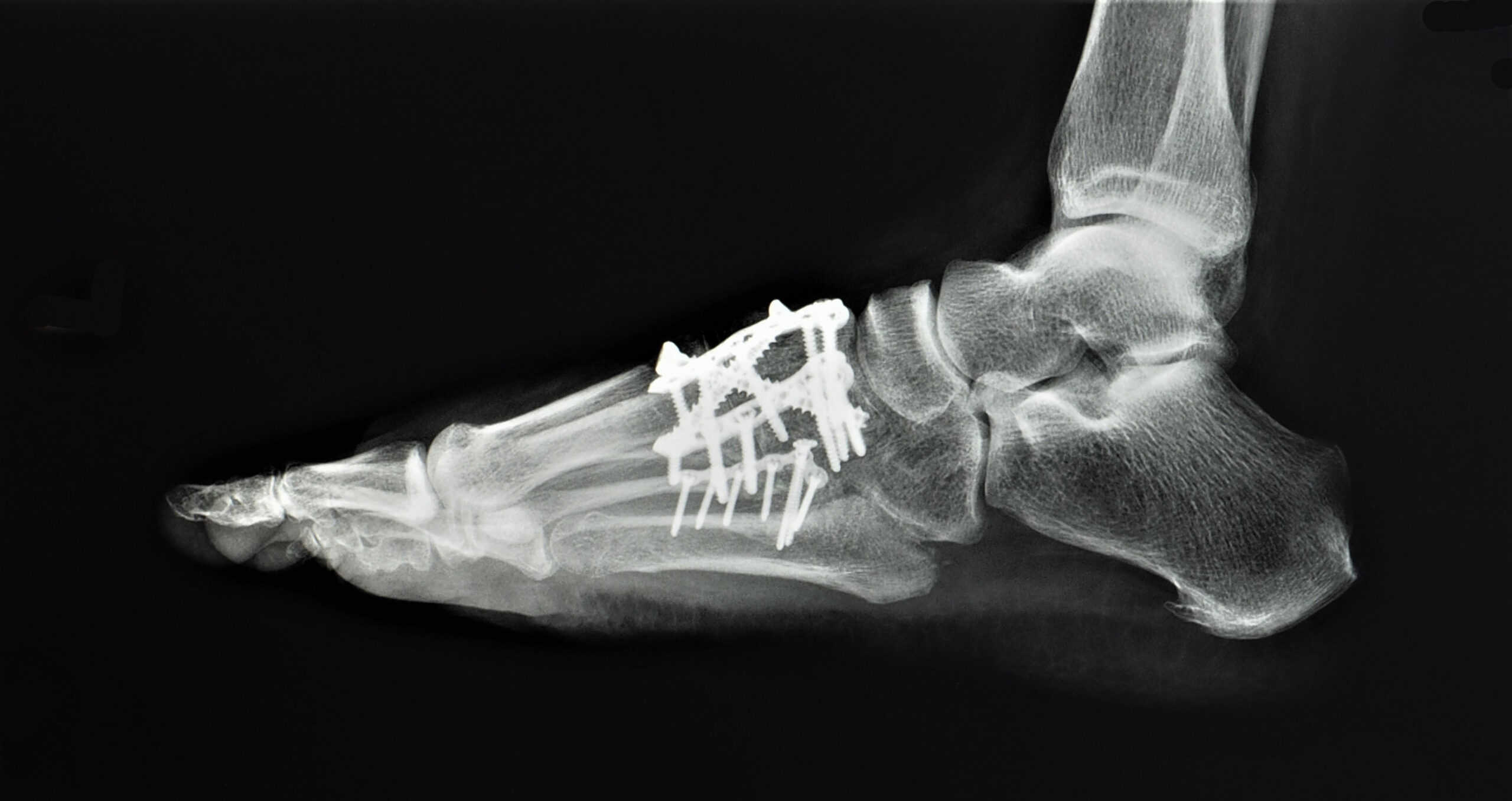 What to Expect Before, During, and After Foot Reconstruction Surgery