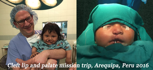 cleft-palate-surgery