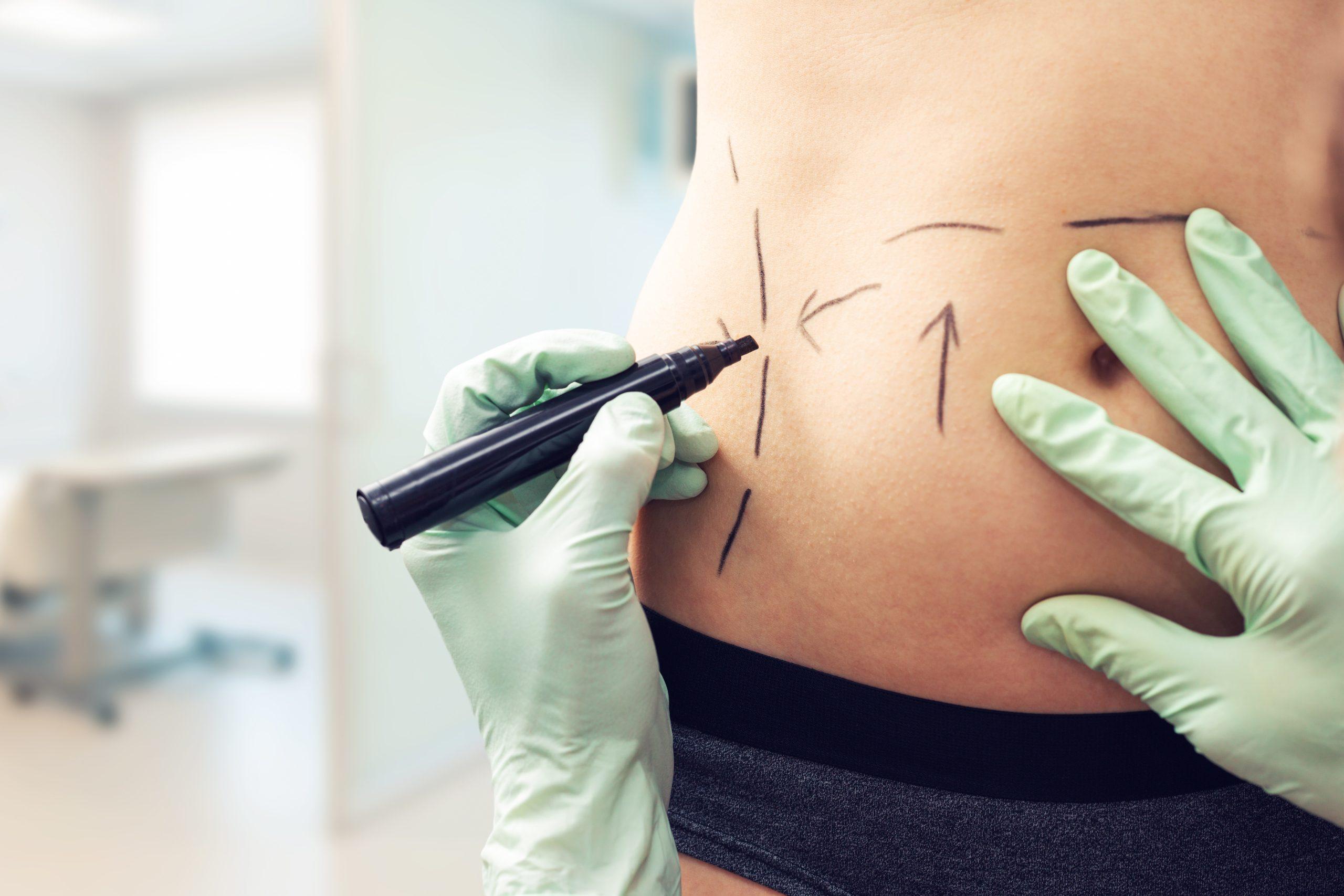 Post-Weight Loss Body Contouring: Surgical Options