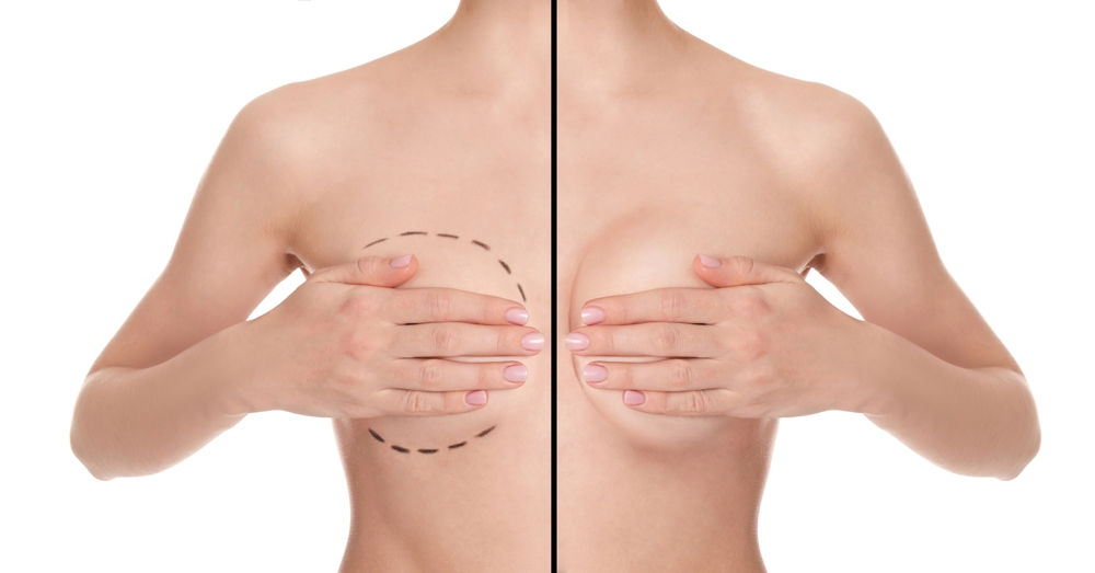 Will My Breasts Look Empty After Explant Surgery?