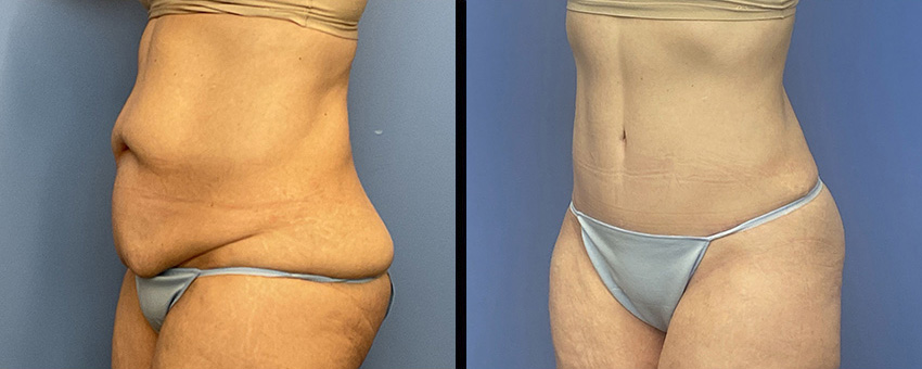 Before and After Image: Abdominoplasty - left-front-oblique