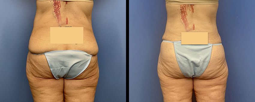 Before and After Image: Abdominoplasty - back