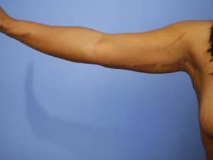 extended brachioplasty