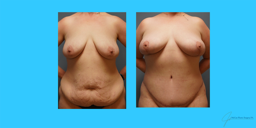 Before and After Image: Abdominoplasty - front