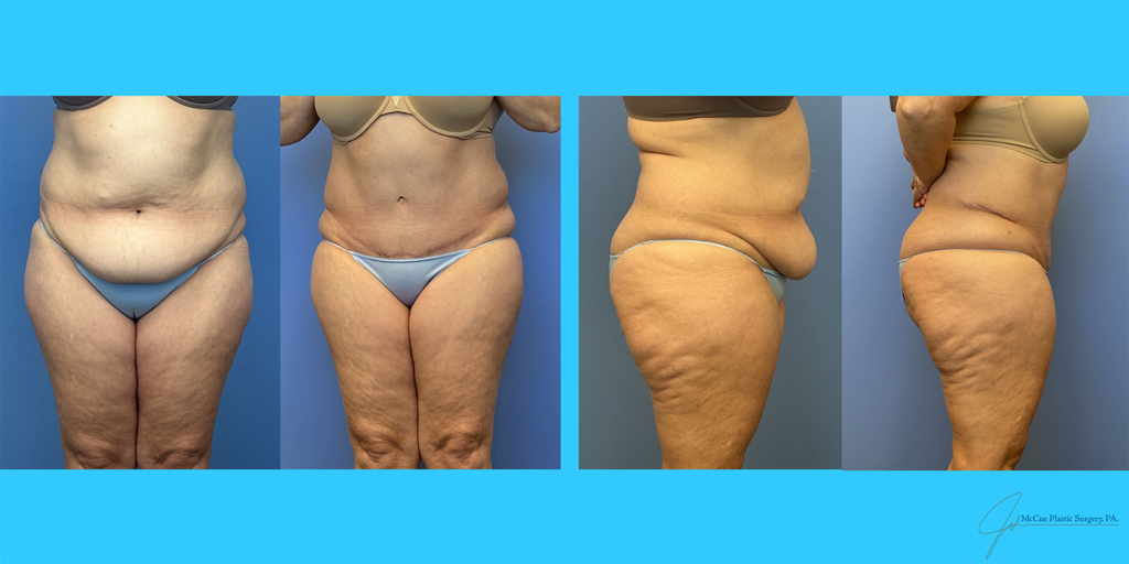 Before and After Image: Abdominoplasty - front