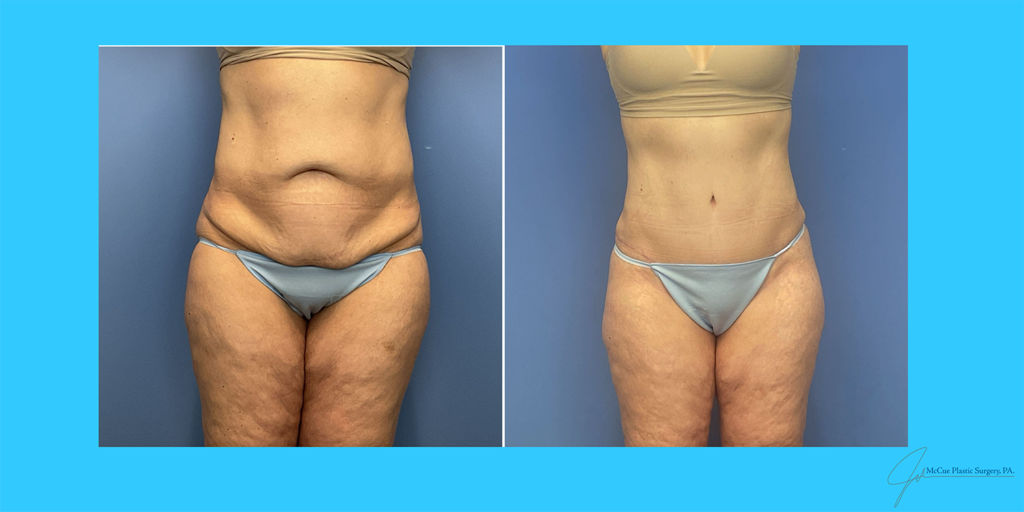 Before and After Image: Abdominoplasty - front