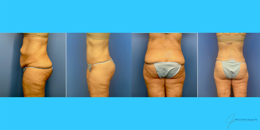 Before and After Image: Abdominoplasty - back