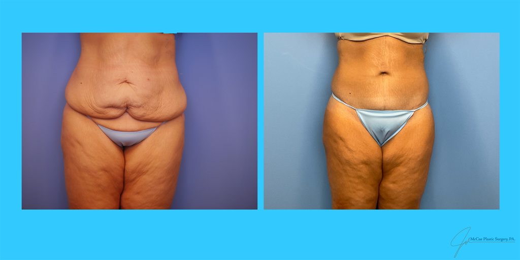 Before and After Image: Abdominoplasty - front