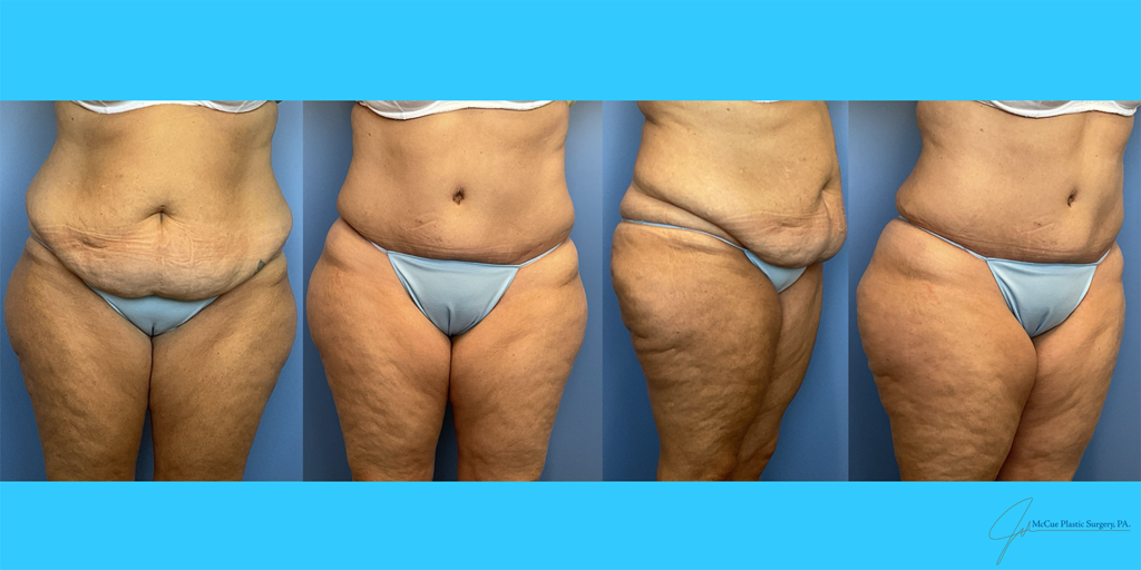 Before and After Image: Abdominoplasty - front