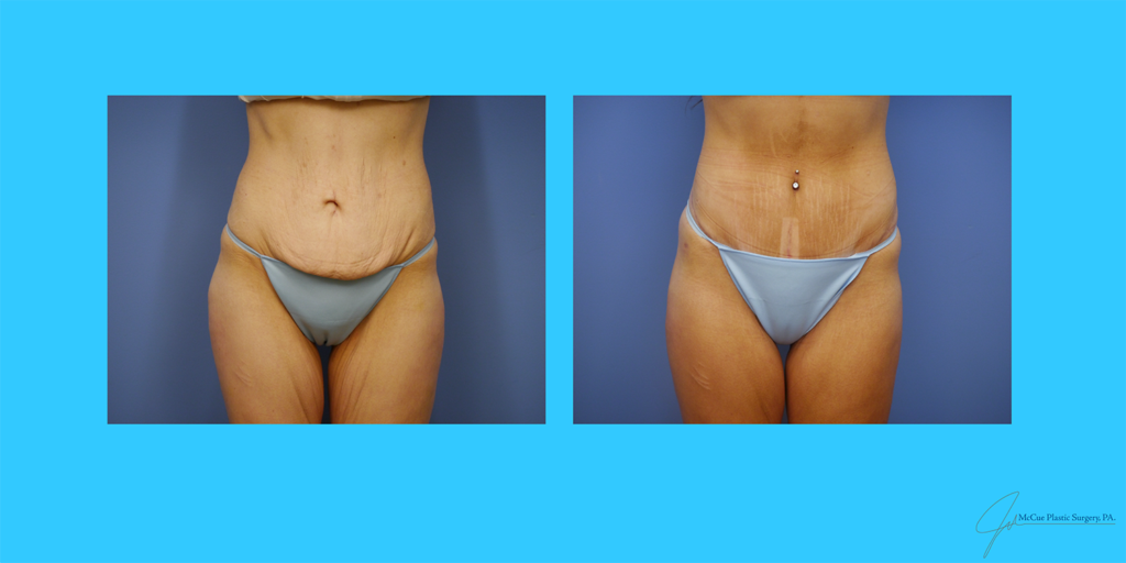Before and After Image: Abdominoplasty - front