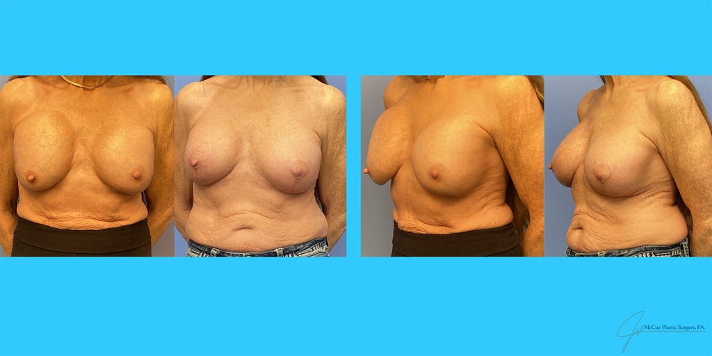 Before and After Image: Breast Augmentation - front