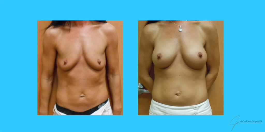 Before and After Image: Breast Augmentation - front