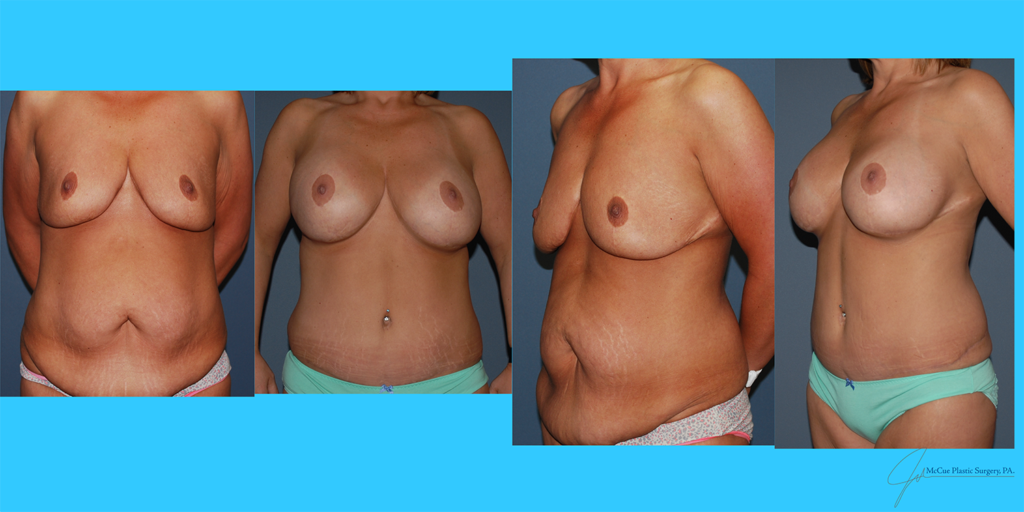 Before and After Image: Breast Augmentation - front