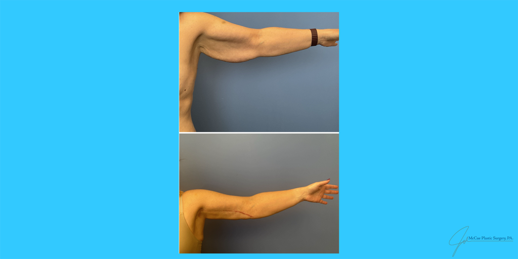 Before and After Image: Brachioplasty - front