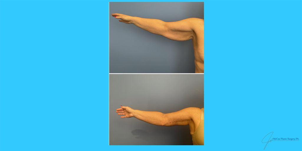 Before and After Image: Brachioplasty - front