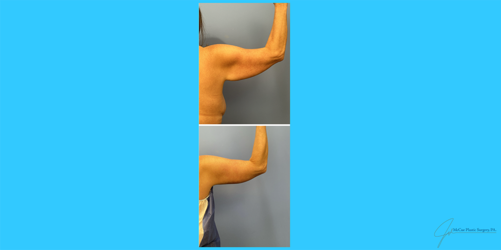 Before and After Image: Brachioplasty - back