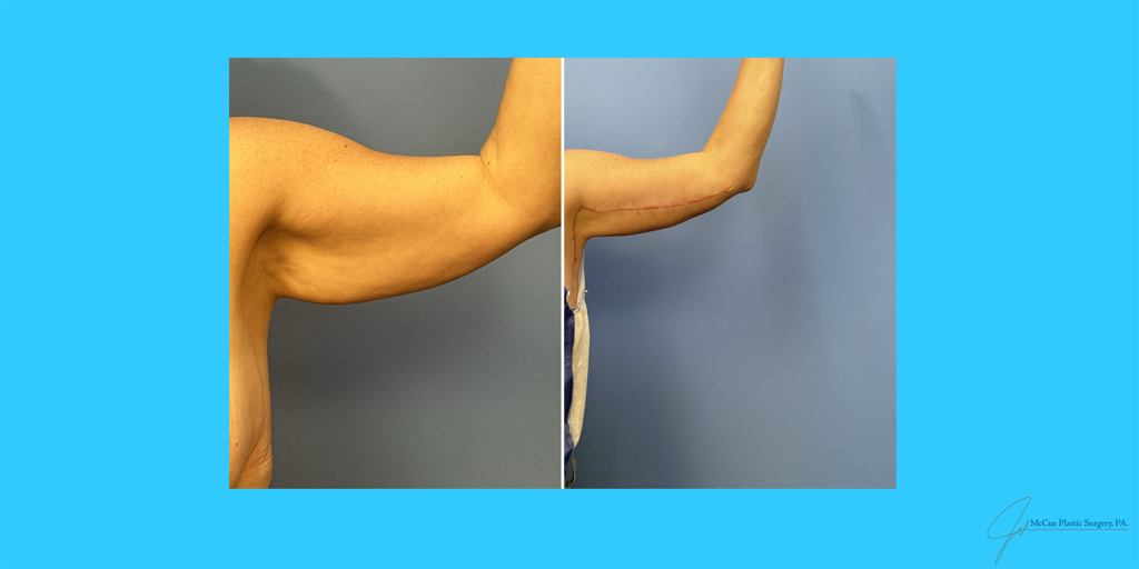 Before and After Image: Brachioplasty - front