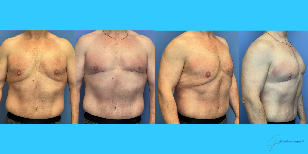Before and After Image: Body Contouring - front