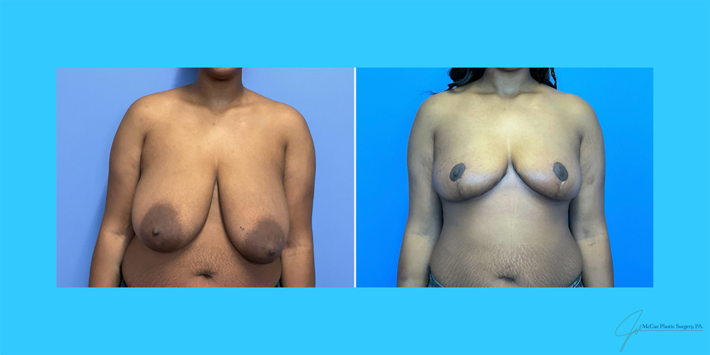 Before and After Image: Breast Reduction - front