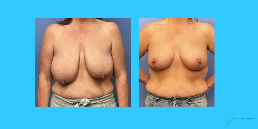 Before and After Image: Breast Reduction - front