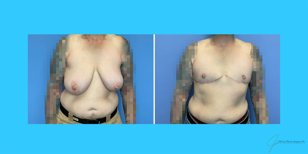 Before and After Image: Top Surgery - front