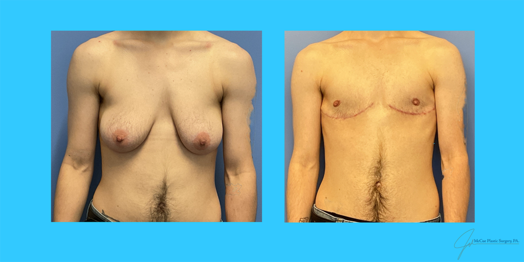 Before and After Image: Top Surgery - front