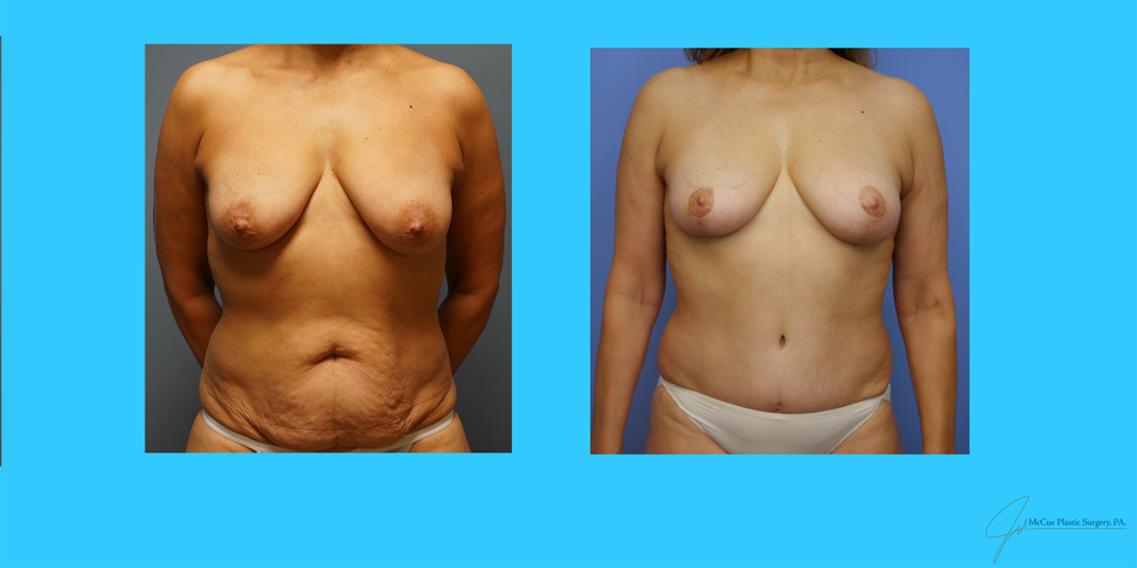 Before and After Image: Abdominoplasty - front