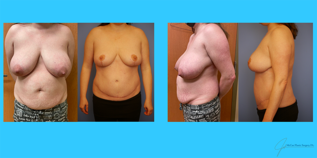 Before and After Image: Abdominoplasty - front