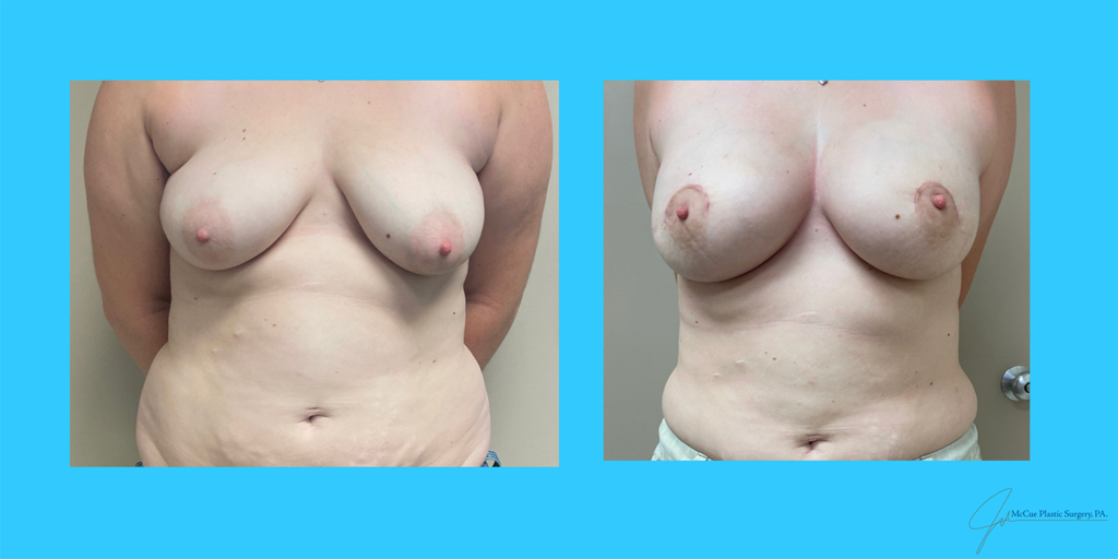 Before and After Image: Breast Augmentation - front