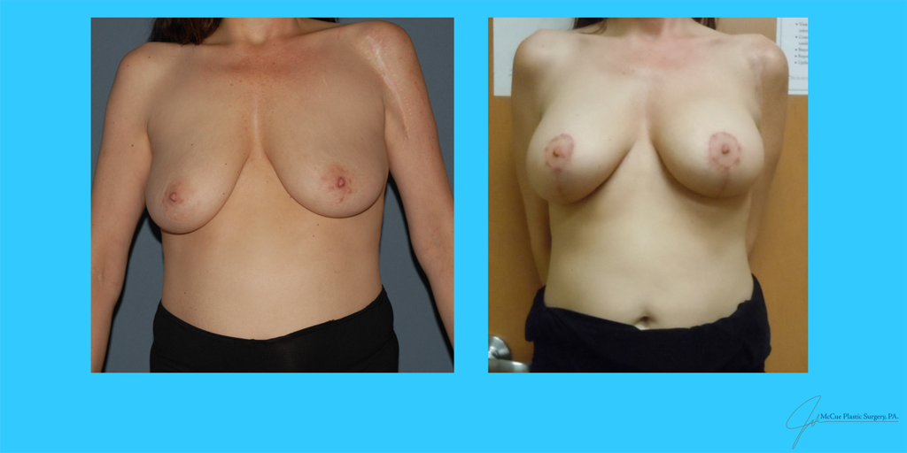 Before and After Image: Breast Augmentation - front