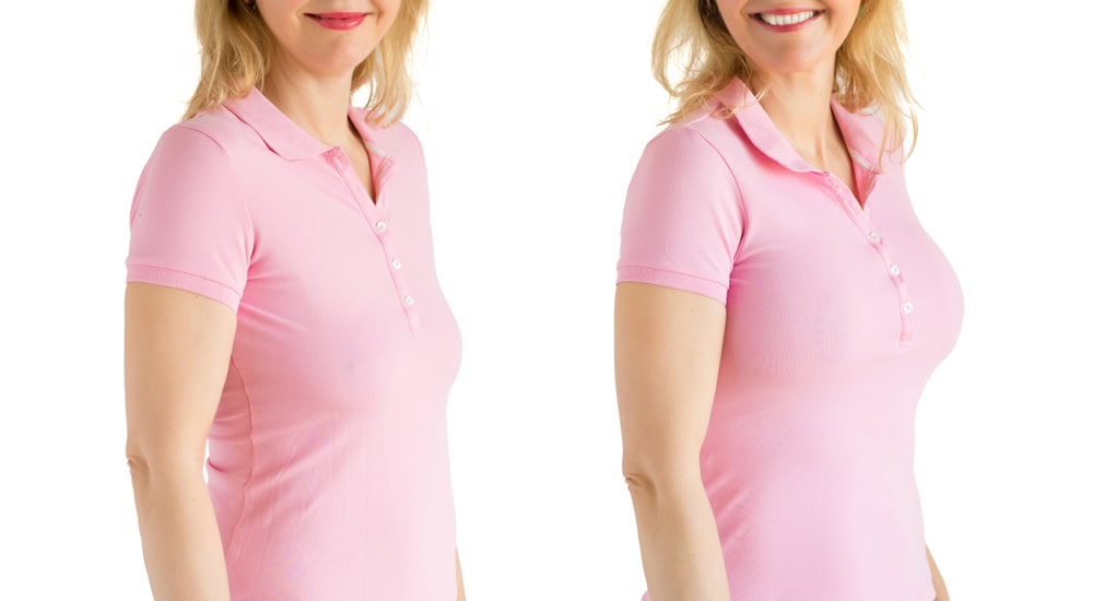 Can You Add Breast Implants to a Breast Lift?