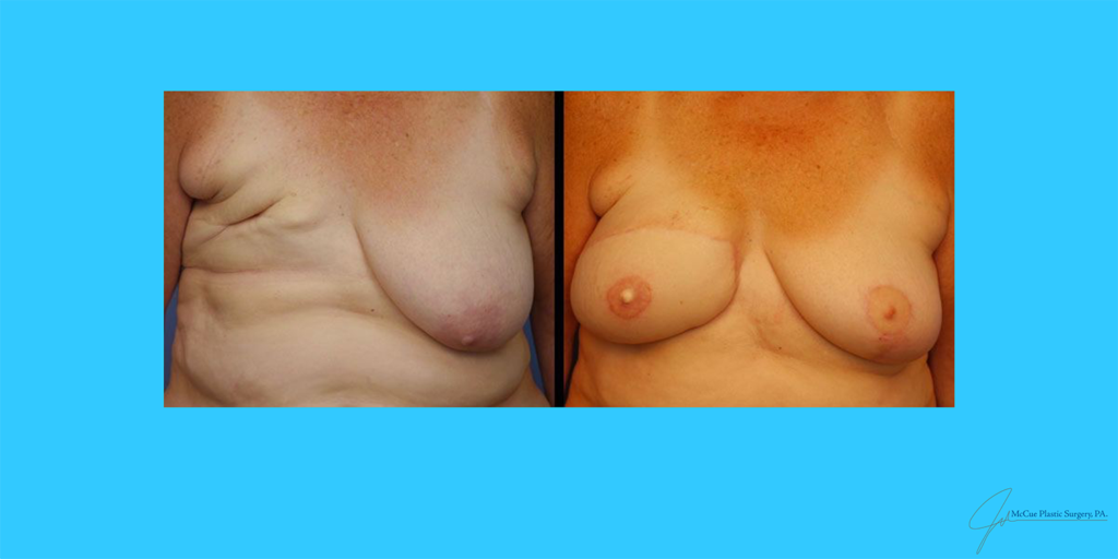 Before and After Image: Free Flap Breast Reconstruction - front