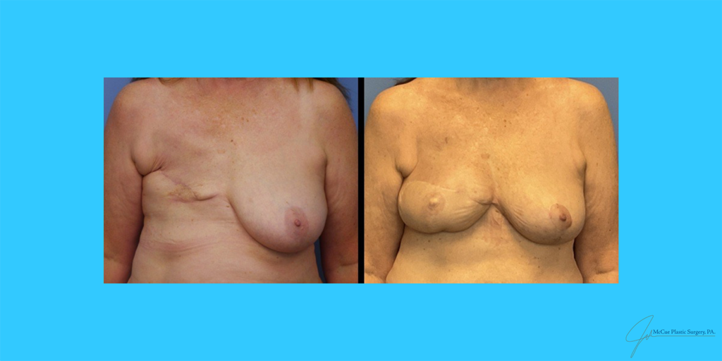 Before and After Image: Free Flap Breast Reconstruction - front