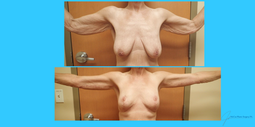 Before and After Image: Mastopexy - front