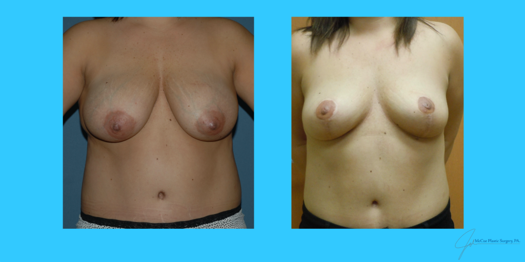 Before and After Image: Breast Reduction - front