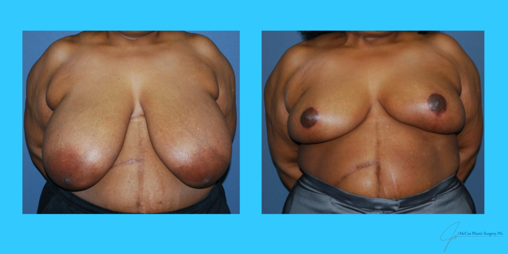Before and After Image: Breast Reduction - front