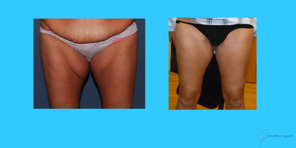 Before and After Image: Thigh Lift - front