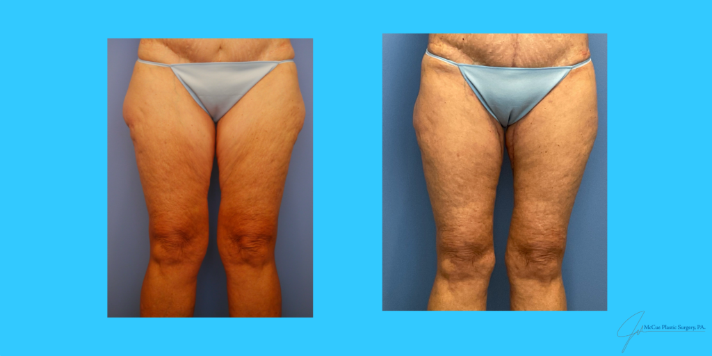 Before and After Image: Thigh Lift - front